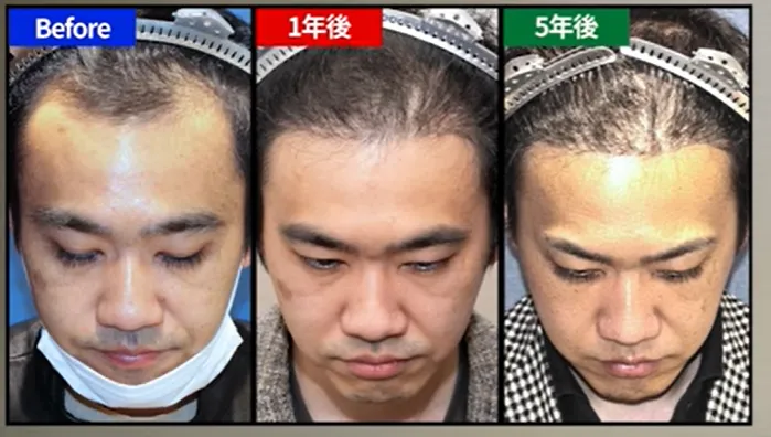 親和クリニック　植毛　5年後
